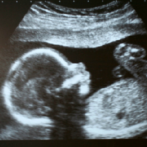 Study: 1 In 5 Pregnancies Aborted