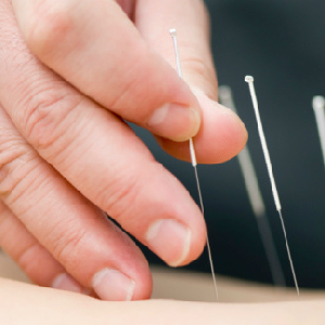 Acupuncture Could Relieve Your Holiday Stress