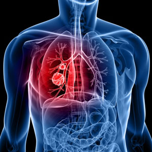 No One Ever Dies of Cancer: The Shocking Truth